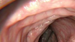 Untreated colorectal polyps can develop into colorectal cancer