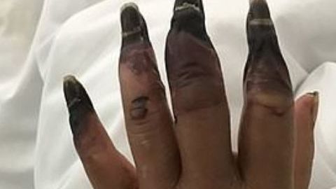 El dilema para la mujer comenzó cuando se desantendió una herida en la mano.