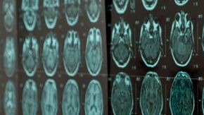 La revolucionaria técnica, denominada Clarity, consiste en un proceso químico  que pone transparente al cerebro sin alterar su forma ni conexiones.