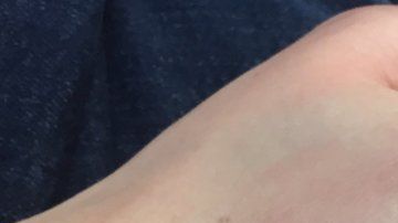 Alice ha sufrido moretones e hinchazones tras golpear cosas.