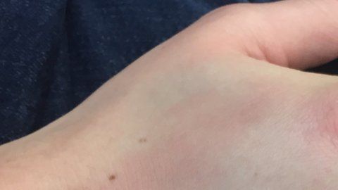 Alice ha sufrido moretones e hinchazones tras golpear cosas.