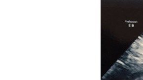 El ultrasonido compartido por la pareja en JustGiving.