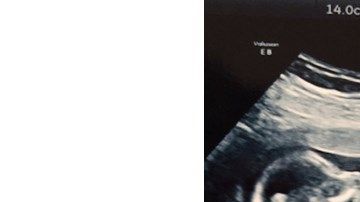 El ultrasonido compartido por la pareja en JustGiving.