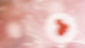 Así se ven las células cancerosas dentro del cuerpo.