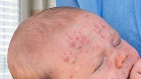 Menos personas vacunadas, una de las causas de los brotes de sarampión.