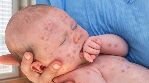 Menos personas vacunadas, una de las causas de los brotes de sarampión.