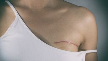 La mastectomía puede realizarse de manera preventiva.