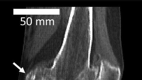 La flecha señala dónde se encuentra el hueso fabela.