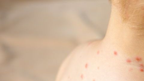 Director de CDC dijo que están trabajando para convencer al más del 5% de personas que deciden no vacunar a sus hijos para que entiendan su importancia.