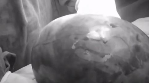 El tumor en el ovario pesaba 7 kilos (aproximadamente, 14 libras).