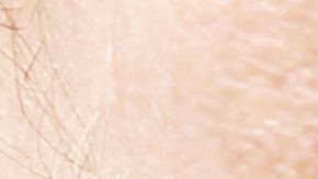 venasvarices-shutterstock_488871253