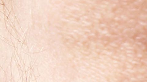 venasvarices-shutterstock_488871253