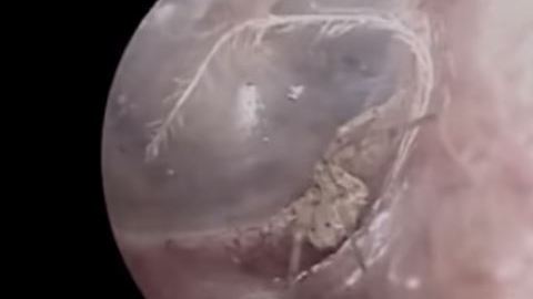 El insecto se resistió a dejar el cuerpo de esta persona.