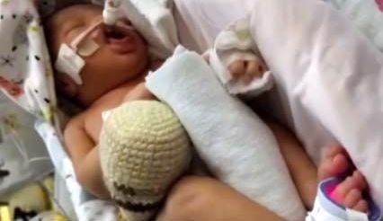 El bebé se encuentra entubado.