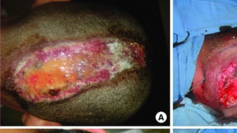 Así le dejaron la cabeza después de colorearle el cabello.