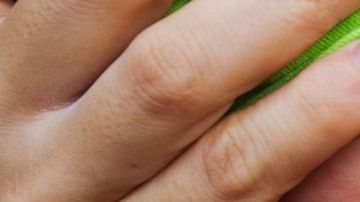 Este año, Estados Unidos ha informado de 704 casos confirmados de sarampión en 22 estados, en comparación con 372 casos en 2018, 120 casos en 2017 y 86 casos en 2016.