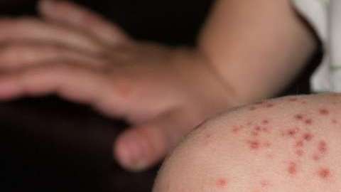 La mejor manera de protegerse contra el sarampión es vacunándose.