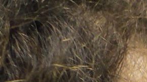 Diversos métodos han sido desarrollados para detectar tipos de cáncer de piel.