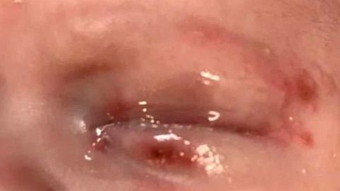 El niño fue contagiado del virus del herpes simple.