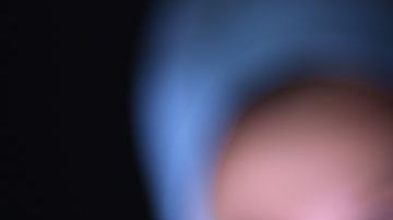 Un trasplante de riñon puede costar 106,000 dólares.