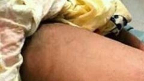 Bebé nació con una protuberancia llamada comúnmente "cola de ratón".