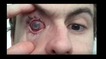 Nick Humphreys muestra su ojo dañado.