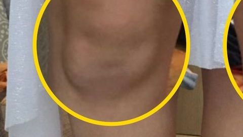 Las rodillas de Beth parecen dos caras de bebé.