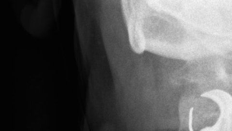 Los médicos encontraron la dentadura postiza del hombre en su laringe más de una semana después de operarlo.