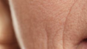 arrugas-en-los-labios