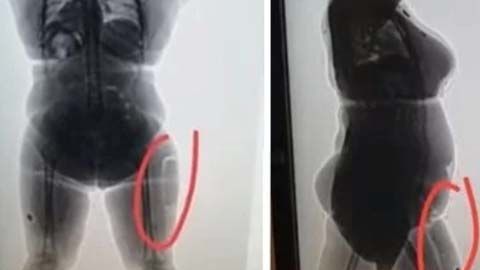Agentes de seguridad detectaron cuerpos extraños en las piernas de la viajera.