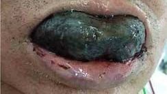 El paciente fue atendido en Mie University Hospital en la ciudad de Tsu.