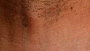 linfoma