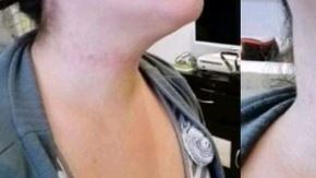 Así quedó el cuello de la víctima.