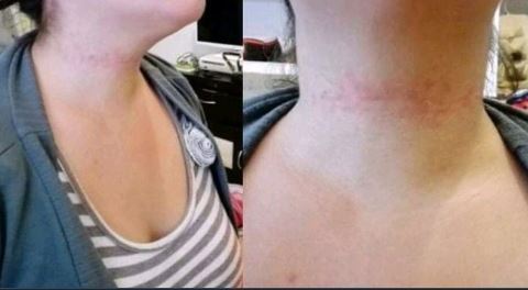 Así quedó el cuello de la víctima.