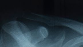 El cáncer de pulmón es el más letal en EEUU.