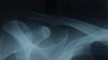 El cáncer de pulmón es el más letal en EEUU.