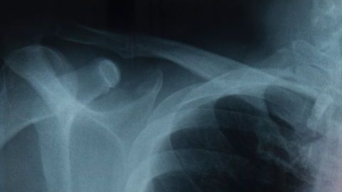 El cáncer de pulmón es el más letal en EEUU.