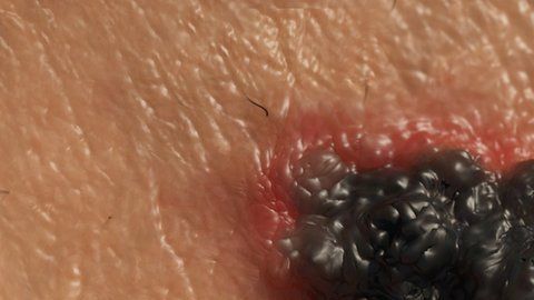 El melanoma se consideraba intratable hasta hace poco.