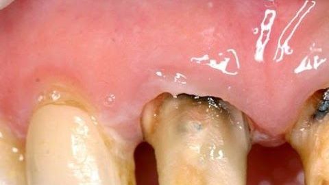 caries-dental