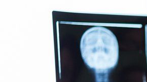 El de pecho es el cáncer más frecuente en las mujeres y afecta globalmente a 2,1 millones de mujeres por año, según la OMS.