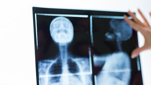 El de pecho es el cáncer más frecuente en las mujeres y afecta globalmente a 2,1 millones de mujeres por año, según la OMS.