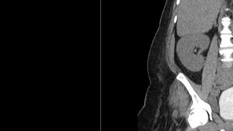 El escroto del hombre se hinchó gradualmente.