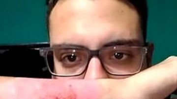 Así quedó su brazo después de eliminar el tatuaje