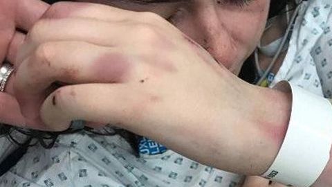 Emily Harvey todavía tiene problemas en los ligamentos de su mano debido al ataque.