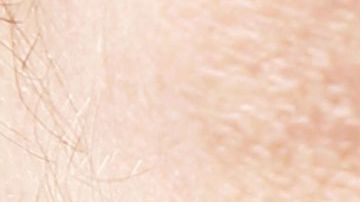 venasvarices-shutterstock_488871253