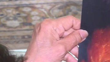 Nisha sufre ictiosis laminar, una rara enfermedad genética cutánea.