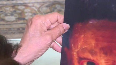 Nisha sufre ictiosis laminar, una rara enfermedad genética cutánea.