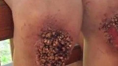 El niño tuvo que ser intervenido por las terribles heridas que le causó el castigo.