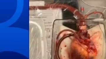 El proceso es conocido “Donación tras la Muerte Circulatoria".