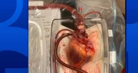 El proceso es conocido “Donación tras la Muerte Circulatoria".